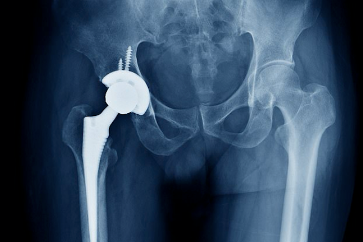 Hip replacement claims due to failure of the replacement